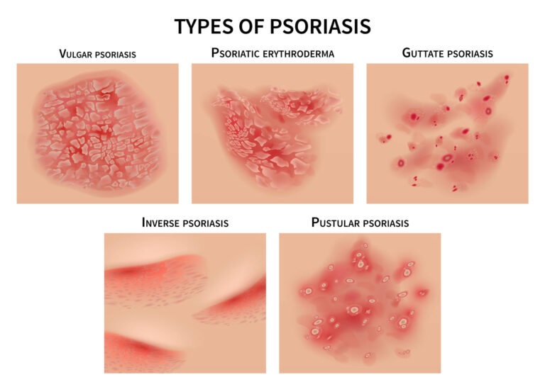 Treating psoriasis naturally - Chaga Mushroom